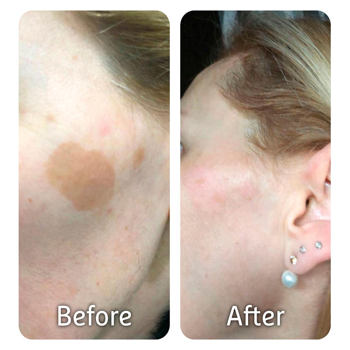 CRYOPEN O - DISPOSITIVO PARA CRIOTERAPIA CON ÓXIDO NITROSO