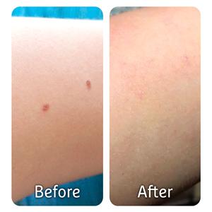 CRYOPEN O - DISPOSITIVO PARA CRIOTERAPIA CON ÓXIDO NITROSO