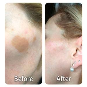 CRYOPEN O - DISPOSITIVO PARA CRIOTERAPIA CON ÓXIDO NITROSO