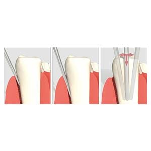 LUXATOR PERIOTOME 3C, HOJA CURVA 3MM, NEGRO - DIRECTA