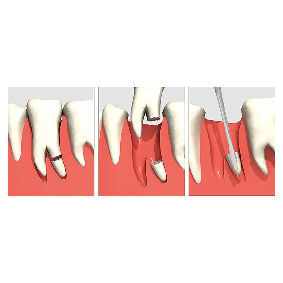LUXATOR DUAL EDGE, DOBLE PUNTA 5MM/3MM, MARRON - DIRECTA