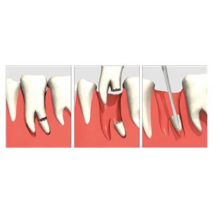 LUXATOR DUAL EDGE, DOBLE PUNTA 5MM/3MM, MARRON - DIRECTA