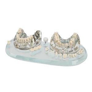 MODELO DENTAL DE IMPLANTES - HAGER WERKEN