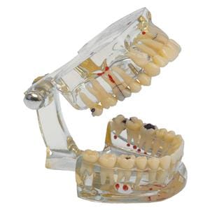 MODELO DENTAL TRANSPARENTE PLUS CARIES 1U - HAGER & WERKEN