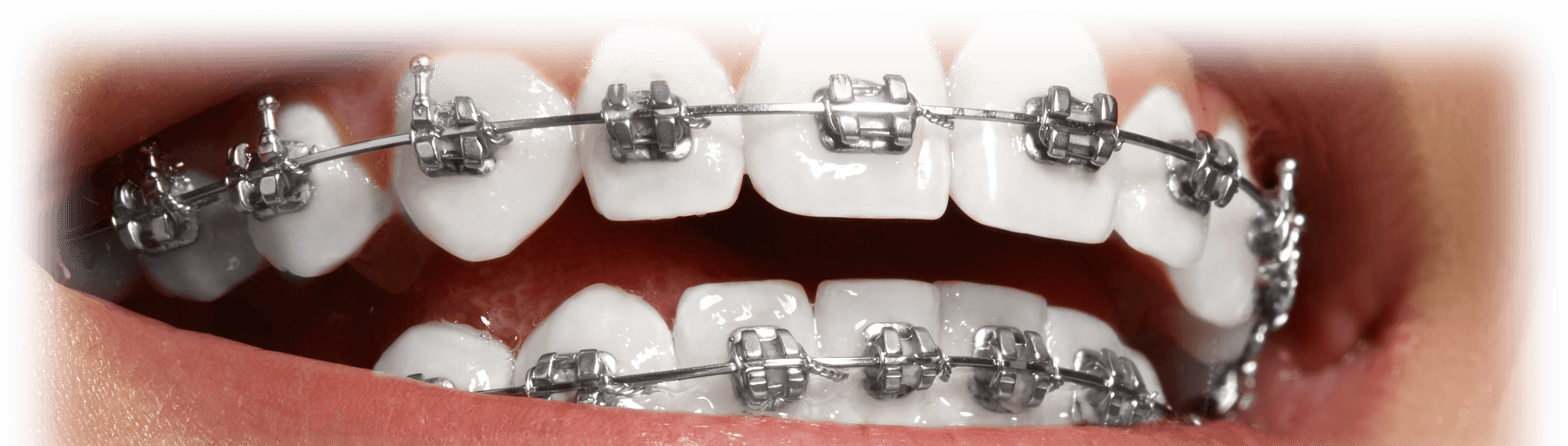 BRACKETS CERÁMICOS