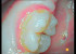 Modo DAYLIGHT de la Cámara intraoral Soprocare