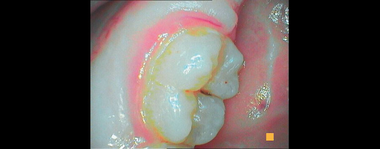 Modo DAYLIGHT de la Cámara intraoral Soprocare