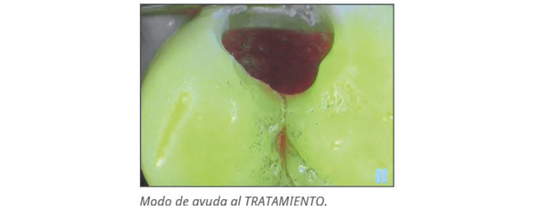 Ayuda al tratamiento de la Cámara intraoral Soprolife