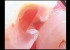 Cavidad abierta con el modo DAYLIGHT de la Cámara intraoral Soprolife
