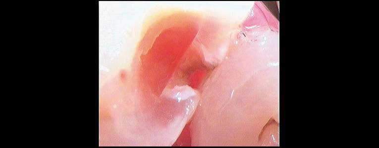 Cavidad abierta con el modo DAYLIGHT de la Cámara intraoral Soprolife
