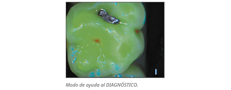 Modo diagnóstico de la Cámara intraoral Soprolife