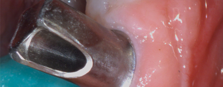 Toma intraoral con la Cámara intraoral VistaCam iX HD Dürr Dental