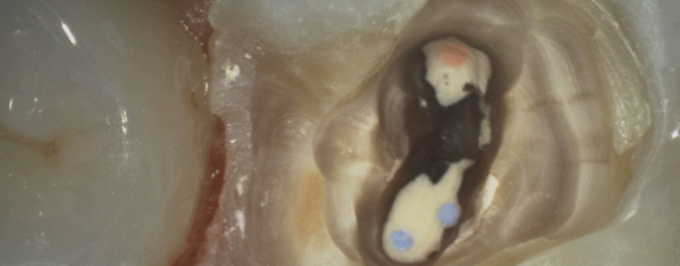 Toma macro con la Cámara intraoral VistaCam iX HD Dürr Dental