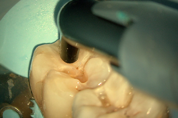 Microscopio dental EXTARO 300 Zeiss: Empaste de composite con el modo TrueLight