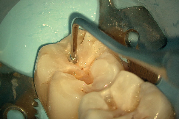 Microscopio dental EXTARO 300 Zeiss: Remodelado del composite con el modo TrueLight