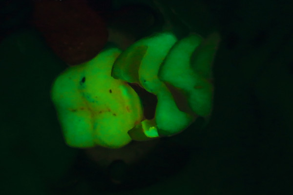 Microscopio dental EXTARO 300 Zeiss: Resultado después del tratamiento con el modo Fluorescence