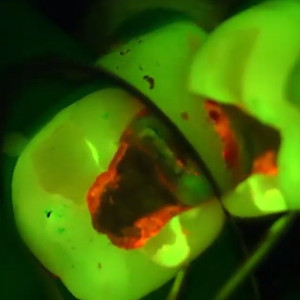 Microscopio dental EXTARO 300 Zeiss: vídeo flourescence mode