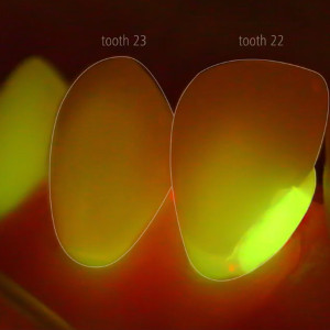 Microscopio dental EXTARO 300 Zeiss: vídeo Closure of Interproximal Space after Loss of the Papilla