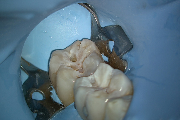Microscopio dental EXTARO 300 Zeiss: Vista aumentada