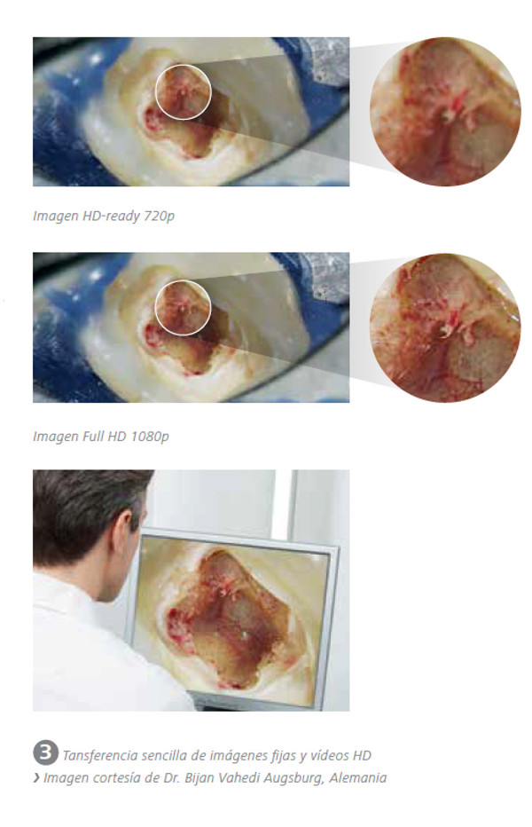 Microscopio dental OPMI Pico MORA Zeiss: Grabación con cámara
