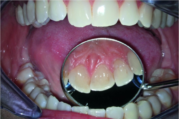 Microscopio dental OPMI Pico MORA Zeiss: Zoom de arcada