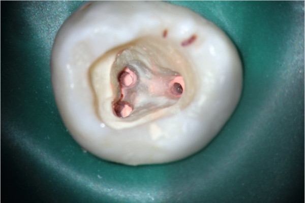 Microscopio dental OPMI Pico MORA Zeiss: Zoom diente