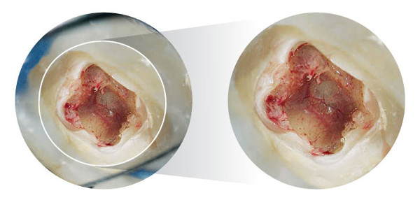Microscopio dental OPMI Pico MORA Zeiss: Aumento
