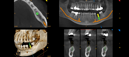 Panorámico CS 8200 3D Carestream: Resultado de las radiografías