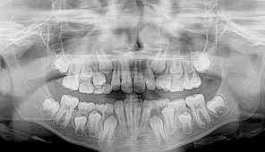 Sensor intraoral RVG 142: Sistemas de radiografía digital con cable RVG 6200