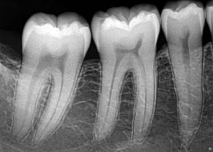Radiografía hecha con el Sensor intraoral XIOS XG Supreme
