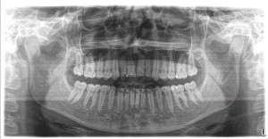 Panorámico ORTHOPHOS SL 2D Dentsply Sirona: Radiografía panorámica