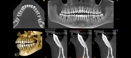 Panorámico CS 8200 3D Carestream: Resultado de las radiografías