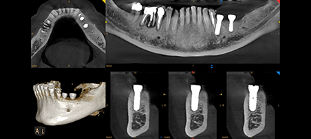 Panorámico CS 8200 3D Carestream: Resultado de las radiografías