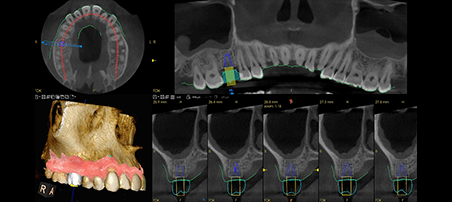 Panorámico CS 8200 3D Carestream: Resultado de las radiografías