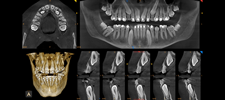 Panorámico CS 8200 3D Carestream: Resultado de las radiografías