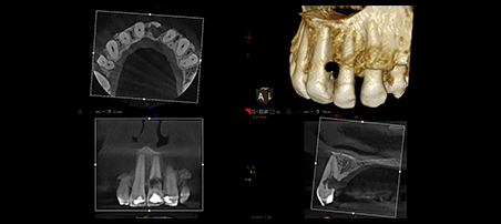 Panorámico CS 8200 3D Carestream: Resultado de las radiografías