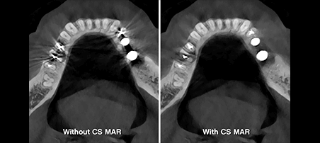 Panorámico CS 8200 3D Carestream: Resultado de las radiografías