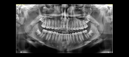 Panorámico CS 8200 3D Carestream: Resultado de las radiografías