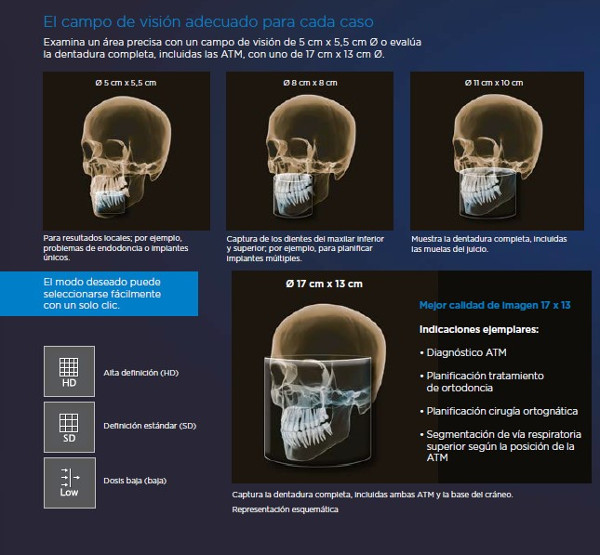 Panorámico AXEOS Dentsply Sirona: Campos de visión