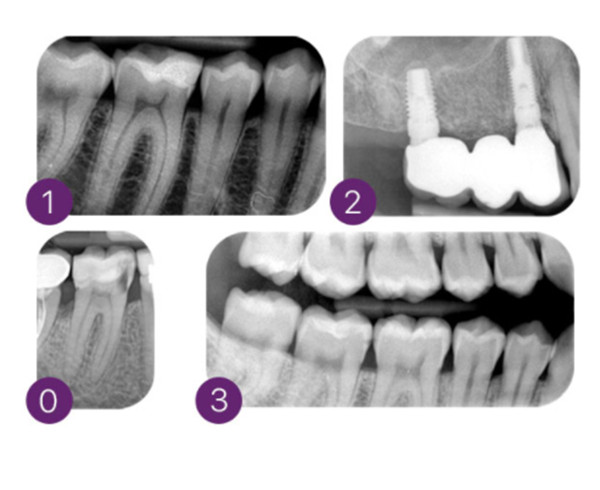 Escáner de placas de fósforo Hy-Scan MyRay: ALTA DEFINICIÓN